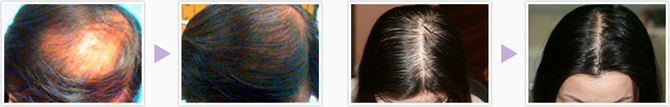 奈良の発毛増毛ハーグ療法はピュアメディカルクリニック　美容外科皮膚科男性女性共